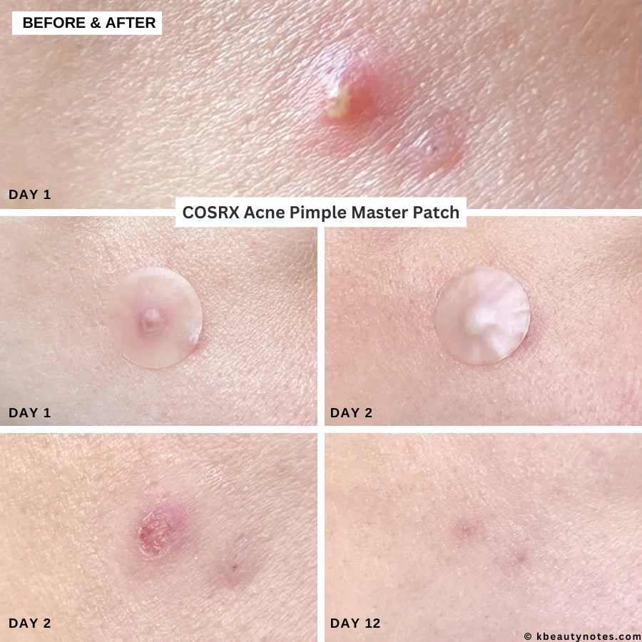 COSRX ACNE PIMPLE MASTER PATCH pleistrai nuo spuogų