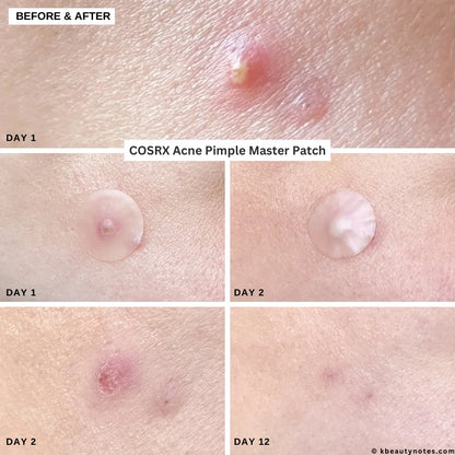 COSRX ACNE PIMPLE MASTER PATCH pleistrai nuo spuogų